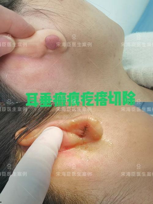 伤疤在线观看,揭开心灵创伤的治愈之旅  第3张